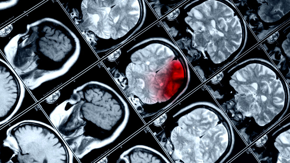 Three or more concussions linked with worse brain function in later life - OXFORD University